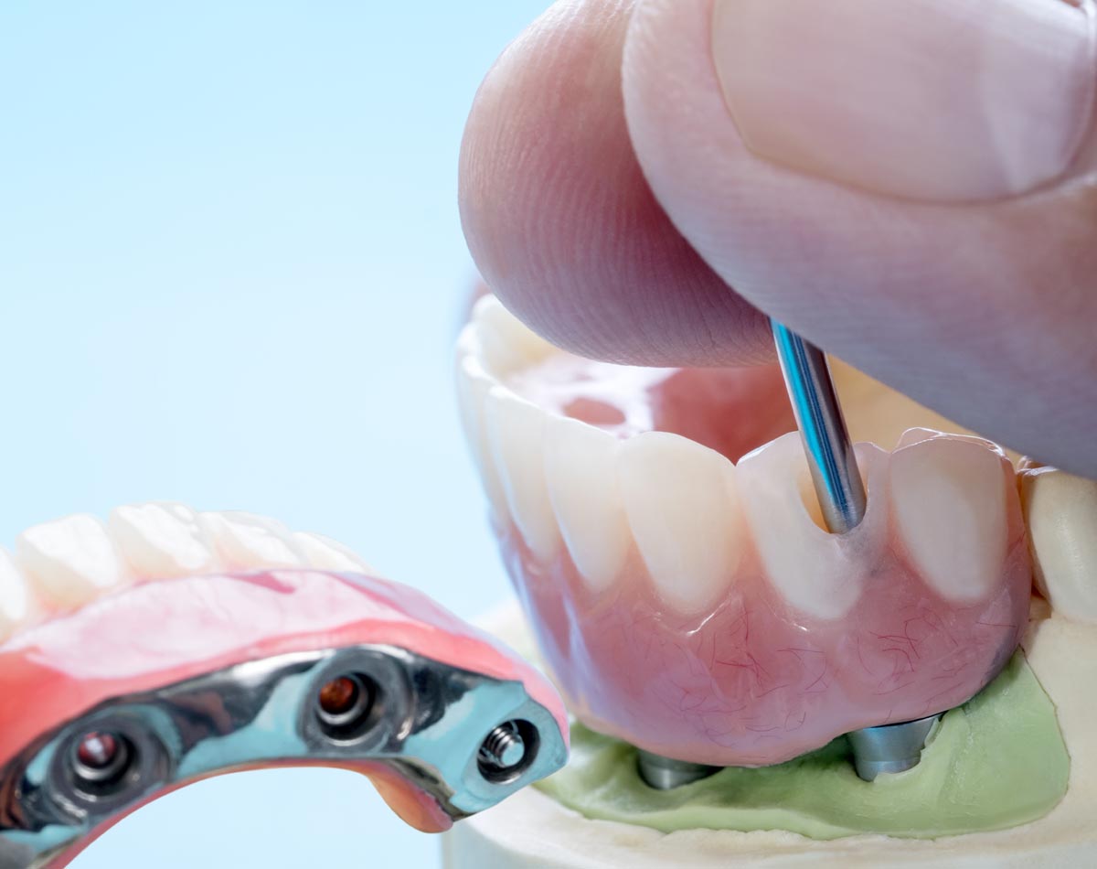 baident-implantologia