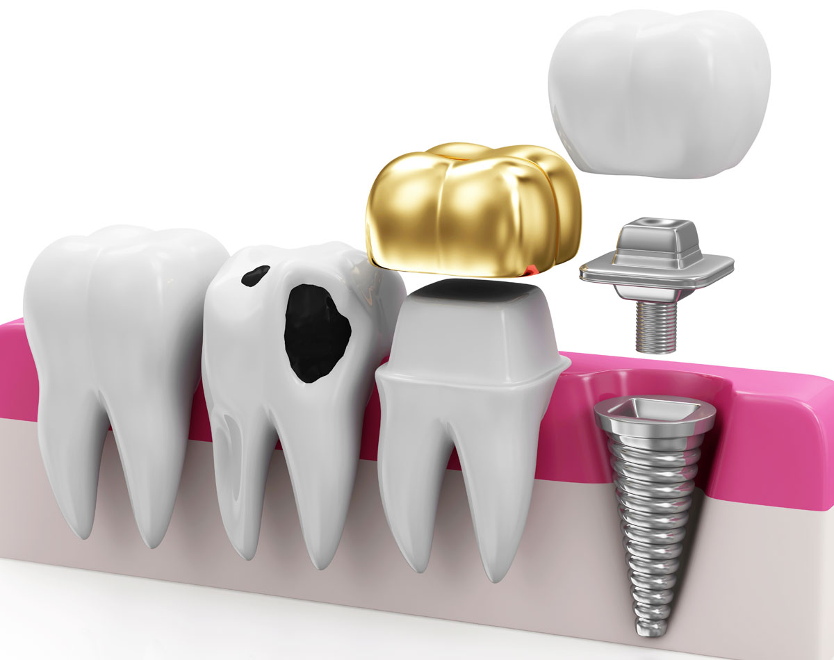 baident-implantologia2