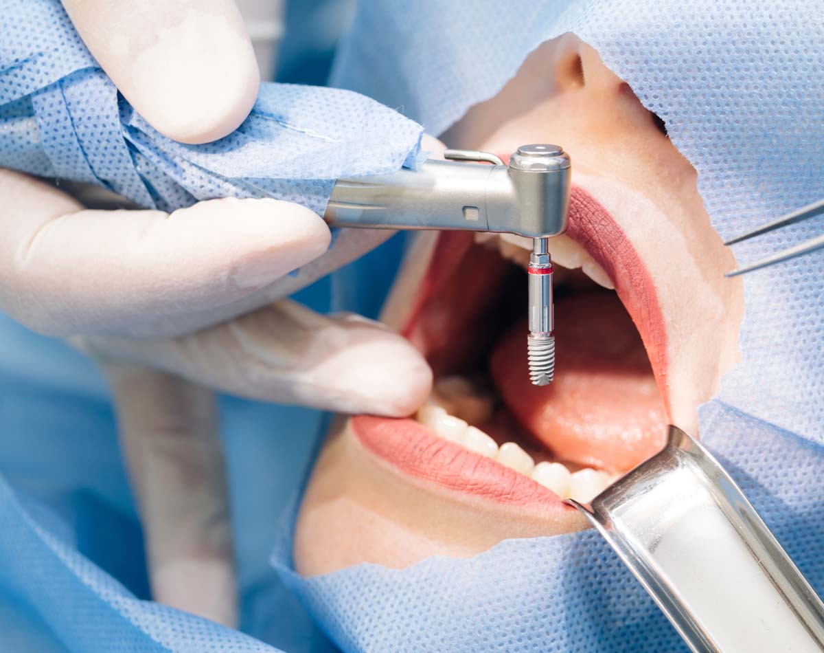 baident-implantologia3